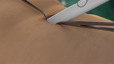 動畫演示免氣腹膽囊切除術